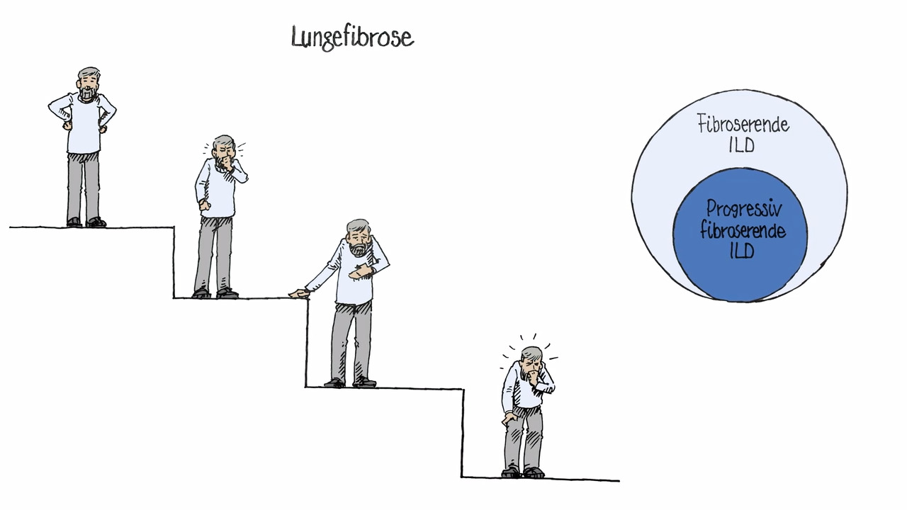 Hva er progressiv fibroserende interstitiell lungesykdom?