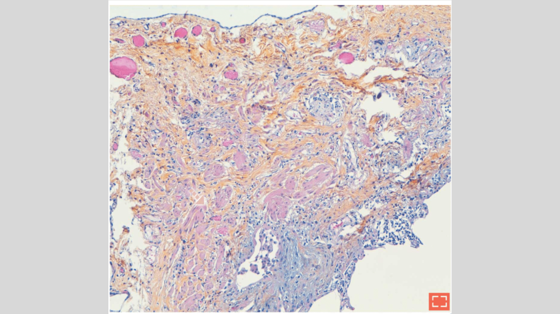 Smooth muscle hyperplasia