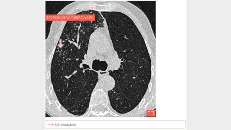 Micronodulation, centrilobular distribution