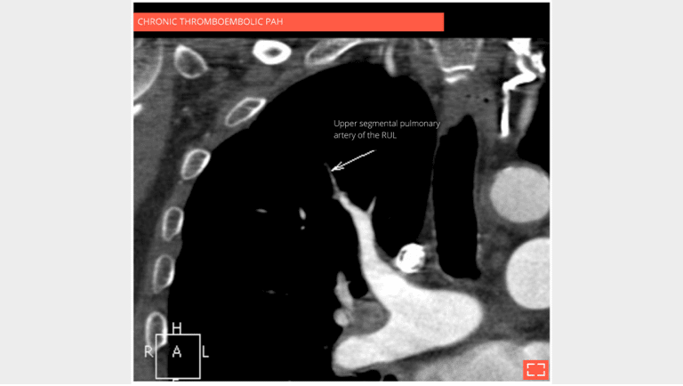 Vascular mosaic attenuation