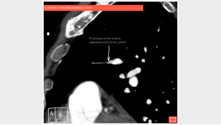 Vascular mosaic attenuation