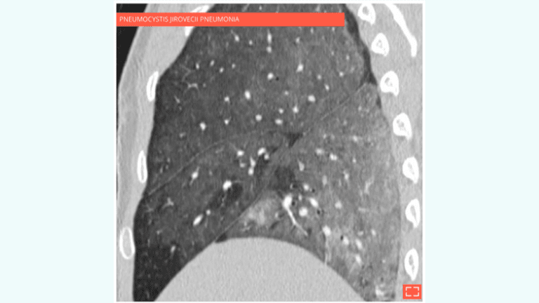 Diffuse ground-glass opacity