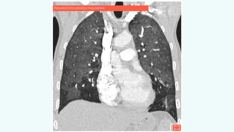 3. Ground-glass opacity