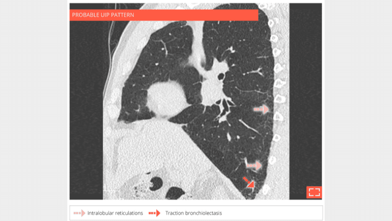 5. Intralobular reticulations