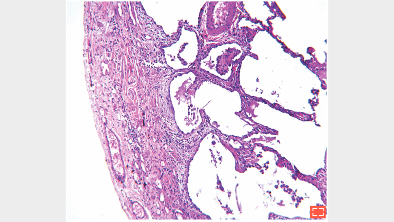 2. Subpleural fibrosis