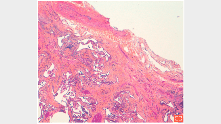 3. Subpleural fibrosis