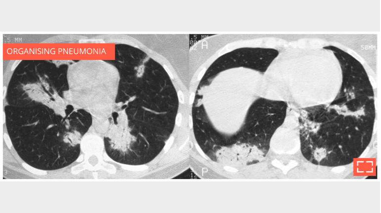 Alveolar consolidation