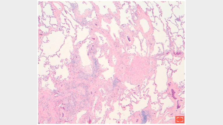 4. Paraseptal fibrosis
