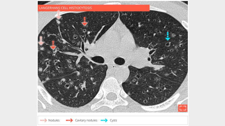 Cyst - nodule