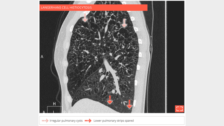 Cysts with "bizarre shape"